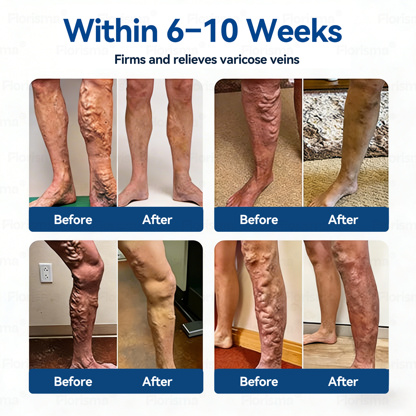 Un parche al día. Alivio visible de las venas en solo 7 días 💪 𝑭𝑳𝑶𝑹𝑰𝑺𝑴𝑨® 𝐃𝐢𝐨𝐬𝐦𝐢𝐧𝐚 𝐲 𝐇𝐞𝐬𝐩𝐞𝐫𝐢𝐝𝐢𝐧𝐚: 𝐏𝐚𝐫𝐜𝐡𝐞 𝐝𝐞 𝐌𝐢𝐜𝐫𝐨𝐧𝐞𝐞𝐝𝐥𝐞𝐬 𝐜𝐨𝐧 𝐅ó𝐫𝐦𝐮𝐥𝐚 𝐝𝐞 𝐆𝐫𝐚𝐝𝐨 𝐂𝐥í𝐧𝐢𝐜𝐨