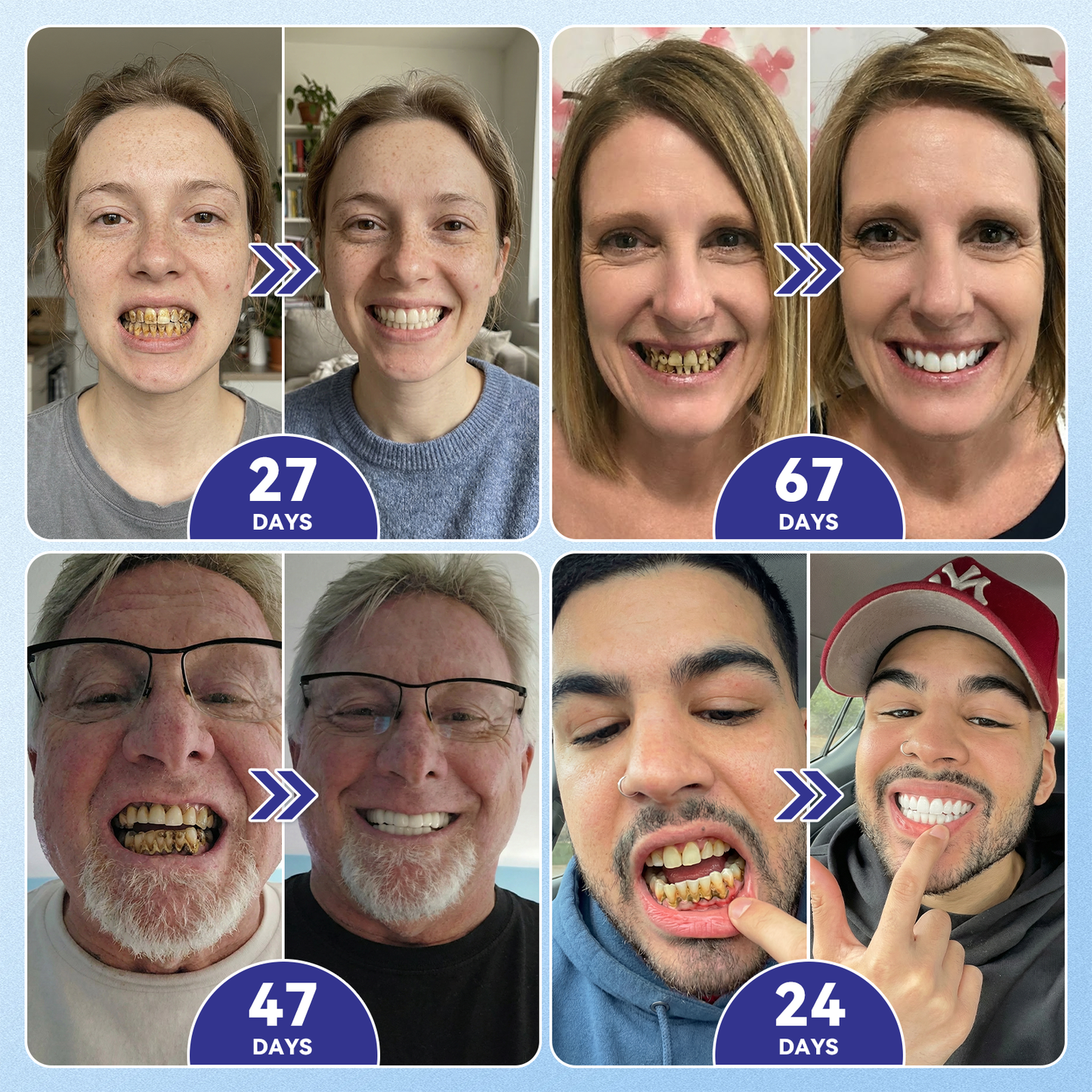 𝐆𝐥𝐢𝐦𝐦𝐞𝐫𝐥𝐲® 🦷 Parche de microagujas con Tideglusib para la reparación de dientes y encías  3.0