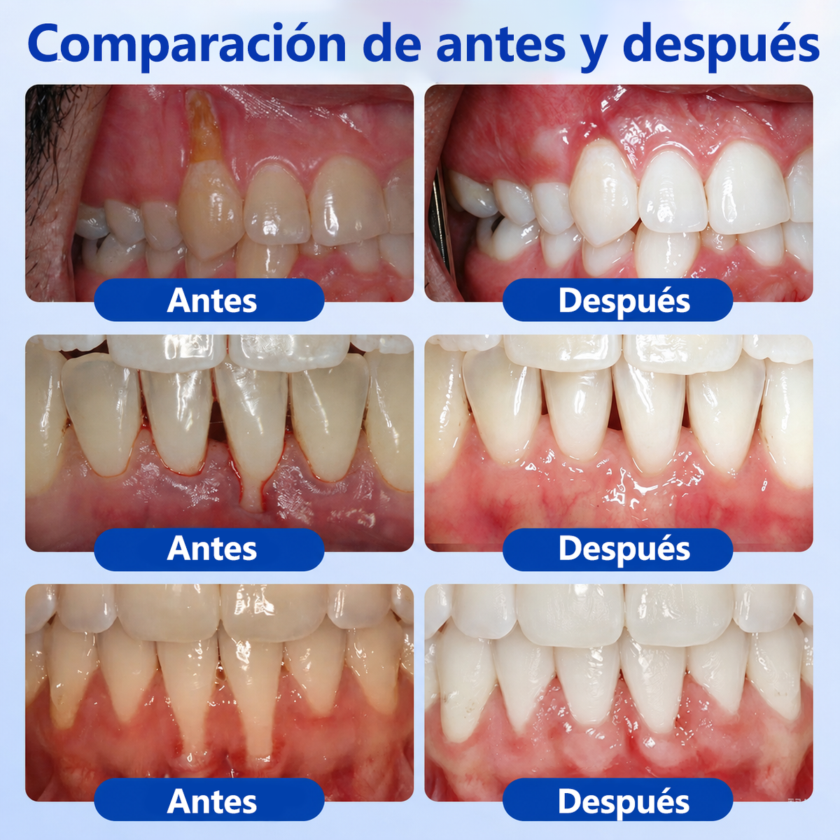 🦷𝑮𝒍𝒊𝒎𝒎𝒆𝒓𝒍𝒚® 𝑮𝒖𝒎𝑹𝒆𝒗𝒊𝒗𝒆 𝑮𝒆𝒍 𝑹𝒆𝒑𝒂𝒓𝒂𝒅𝒐𝒓 𝑷𝒆𝒓𝒊𝒐𝒅𝒐𝒏𝒕𝒂𝒍 🧸